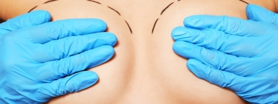 Implante híbrido: Estudo inicial com 279 unidades de um implante mamário inovador