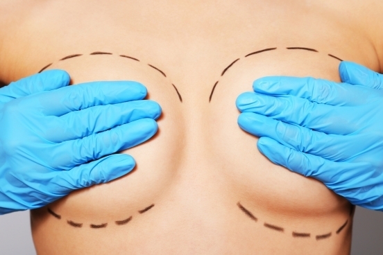 Implante híbrido: Estudo inicial com 279 unidades de um implante mamário inovador