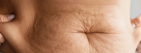 Para onde vai a gordura da lipo? Saiba quando reutilizá-la em outros procedimentos