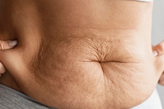 Para onde vai a gordura da lipo? Saiba quando reutilizá-la em outros procedimentos